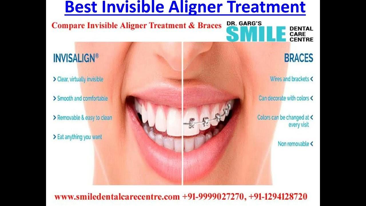 Painless Root Canal Treatment Procedure & Side Effect And Dangers YouTube