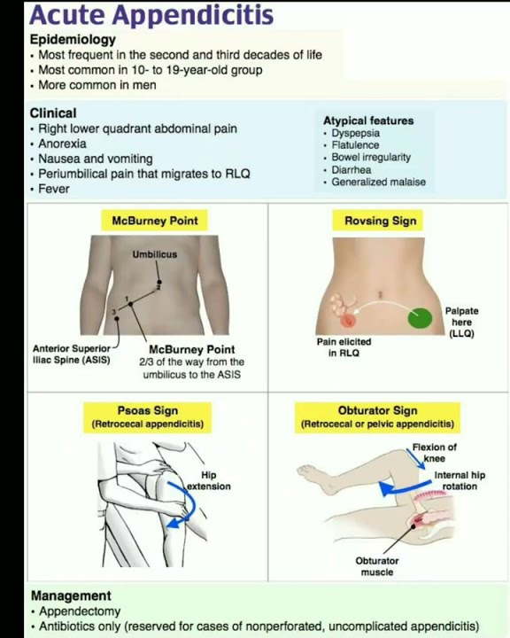 Acute Appendicitis Four signs McCBurney's Point Rovsings sign Psoas ...