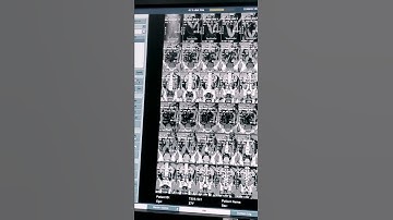 Cect kub!!3D image!! radiology department!!ct scan!!