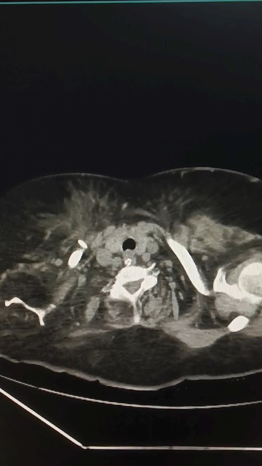 CECT CHEST / plural iffusion in lungs 🫁 chest infected viral 