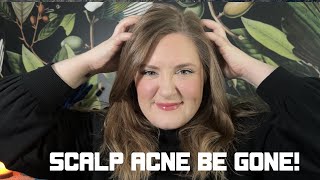 BEAUTY STRATEGY | How to manage Scalp Acne | Scalp Care Tips, Tricks & Products