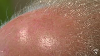 Mayo Clinic Minute: Dermatologist discusses male pattern-baldness