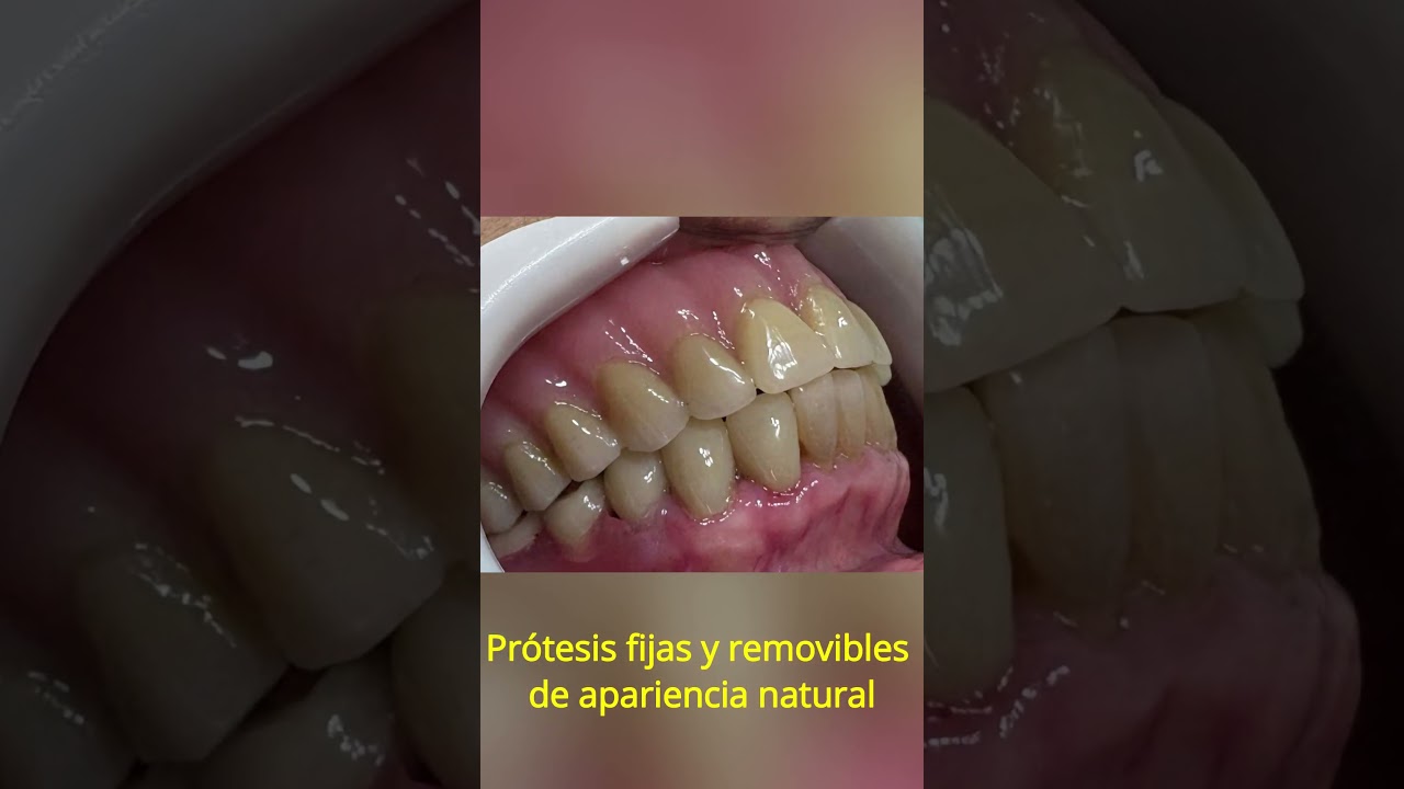 Recupera la seguridad de tu sonrisa con nuestra prótesis dentales