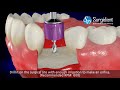 Surgident Implant Positioning Kit without Guide Stent (SD-IPO) - 2