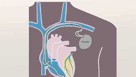 Pacemaker Implant