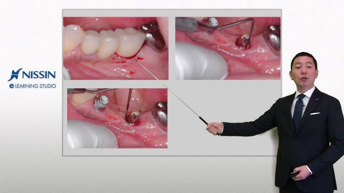 プラスティックサージェリーを究める 結合組織移植 インプラント周囲におけるplastic Surgery Youtube プラスティックサージェリーを究める 結合組織移植 インプラント周囲におけるplastic Surgery Youtube