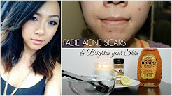How to Fade Acne Scars and Brighten Your Skin at Home - DIY Remedies  | MISSYANYI