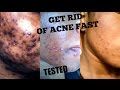 ACNE HACKS || THIS ACTUALLY WORKS