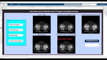 Pancreatic Cancer Detection from CT Images using Deep Learning | MATLAB IEEE Final Year Project 2024