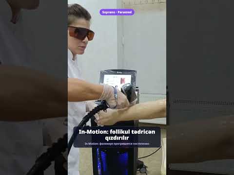 Arm laser hair removal — Soprano ICE Platinum