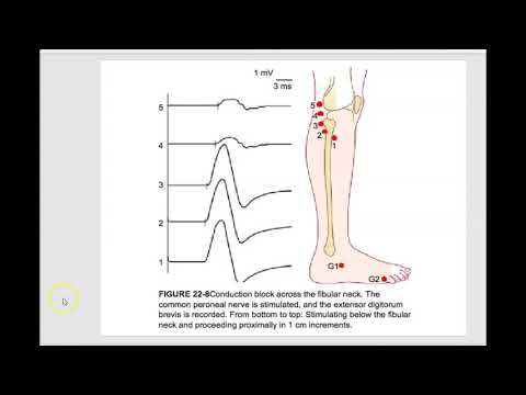 Vidéo: Neuropathie Du Nerf Péronier