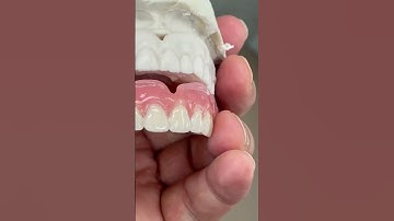 Duplicate denture but High esthetics!