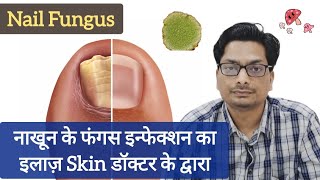 नाखून की फंगस इन्फेक्शन का इलाज़ | Treating Fungal Infection in Nails | Nail Fungus (Hindi) #fungus