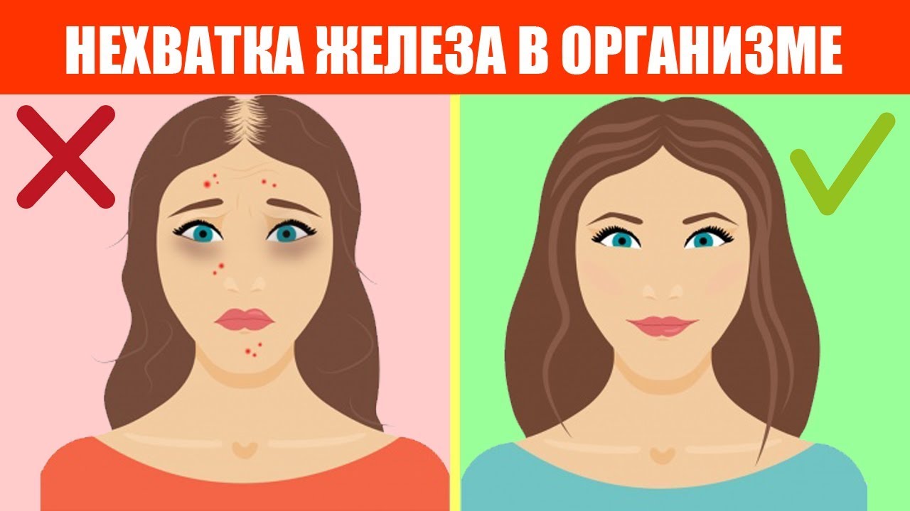 Железо не усваивается? Вот почему и как это исправить! 💪