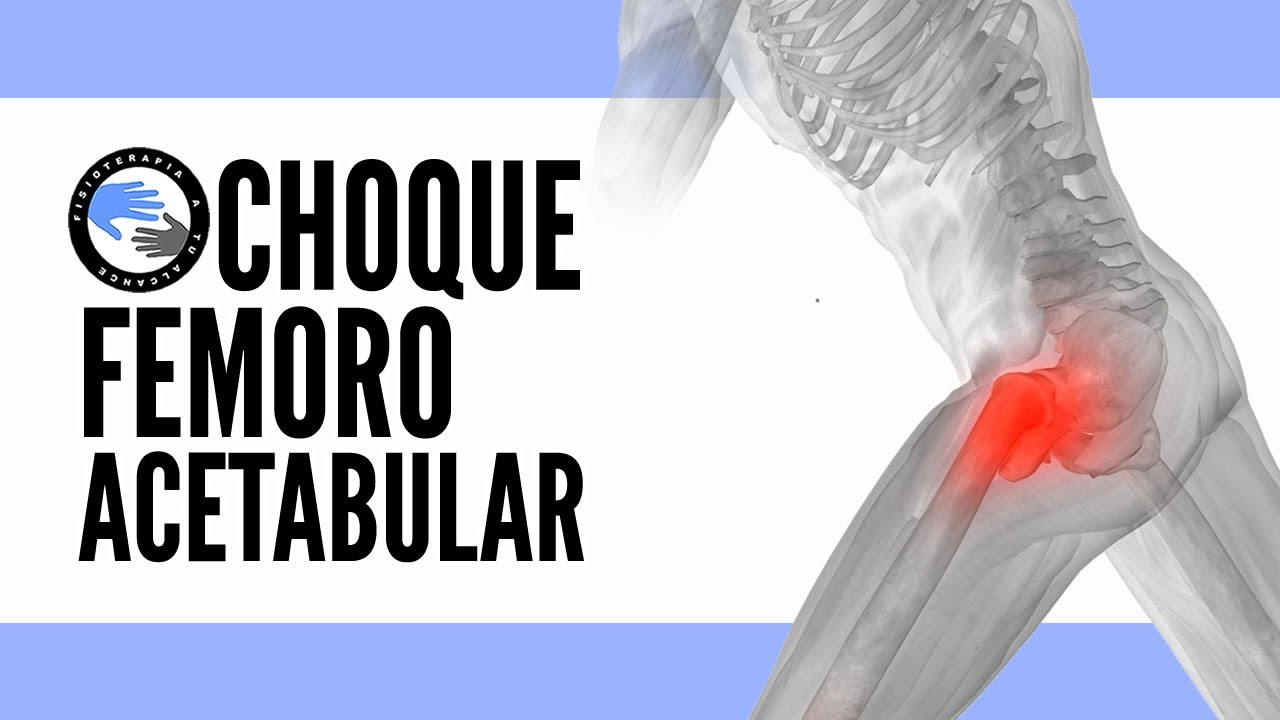 Choque femoroacetabular 5 ejercicios que te ayudaran a mejorar la movilidad y el dolor de cadera