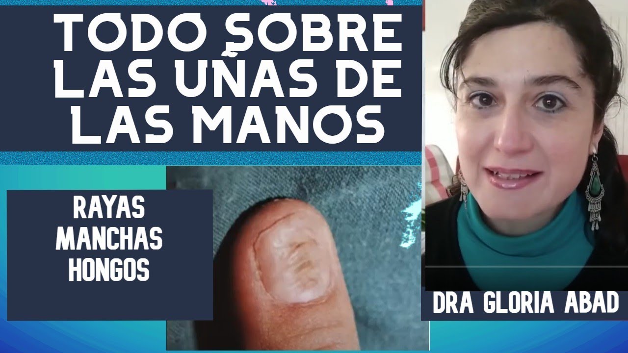 ¿Cuáles son las causas comunes de las rayas en las uñas?