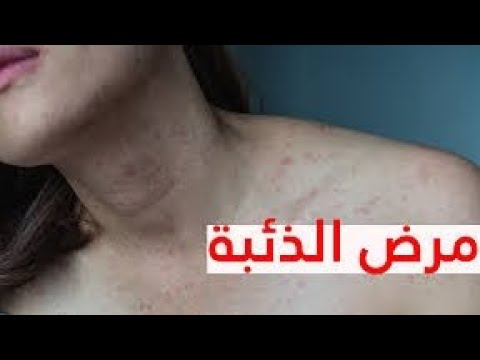 الذئبة الحمراء مرض الذئبة الحمراء اعراض الذئبة الحمراء اسباب الذئبة الحمراء علاج الذئبة الحمراء