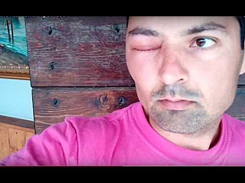 Bee Sting Into The Vein Swelling Of Face You Bee Sting Into The Vein Swelling Of Face