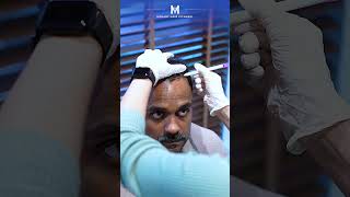 Hair Transplant in Istanbul | Medart