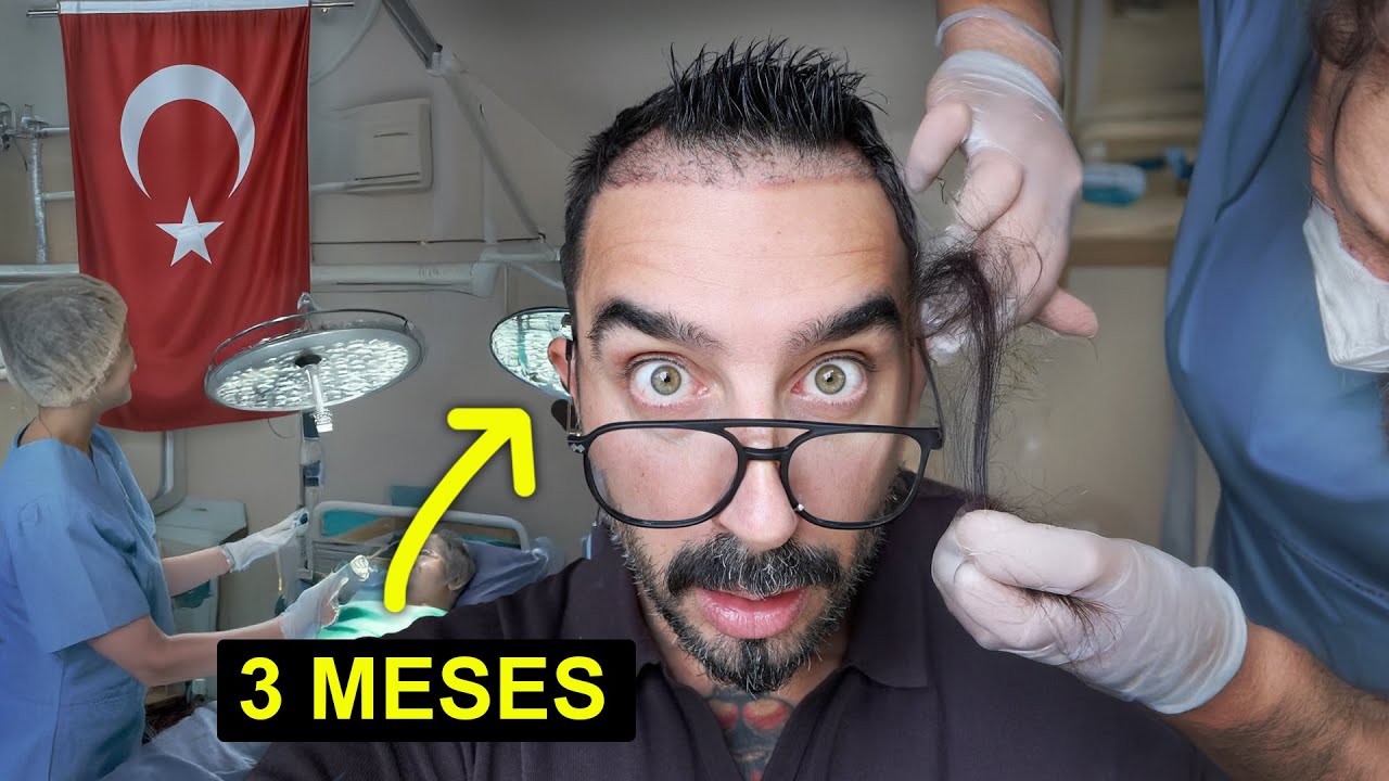 3 Meses después de mi Injerto Capilar en Turquía ¿Fue un error?