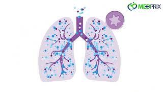 What is FeNO Testing ? | airway inflammation commonly associated with asthma