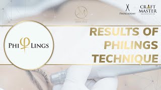 Philings, Microneedling and Phi-Ion(plasma pen) technique