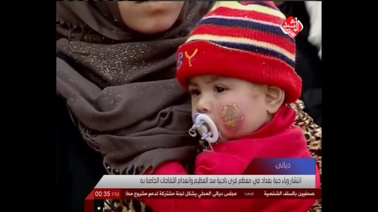 انتشار وباء حبة بغداد في معظم قرى ناحية سد العظيم وانعدام اللقاحات الخاصة به