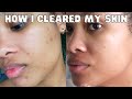 sharing my entire hormonal acne journey + HOW I HEALED MY SKIN (and body)!