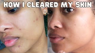 sharing my entire hormonal acne journey + HOW I HEALED MY SKIN (and body)!