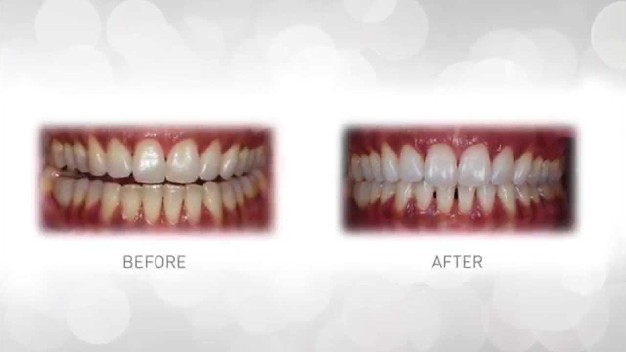 WhiteWash Laboratories Teeth Whitening YouTube