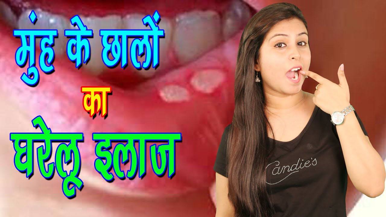 मुँह के छालों का घरेलू ईलाज Home Remedies For Mouth Ulcers Muh Ke Chaale Ka Desi Ilaj Health