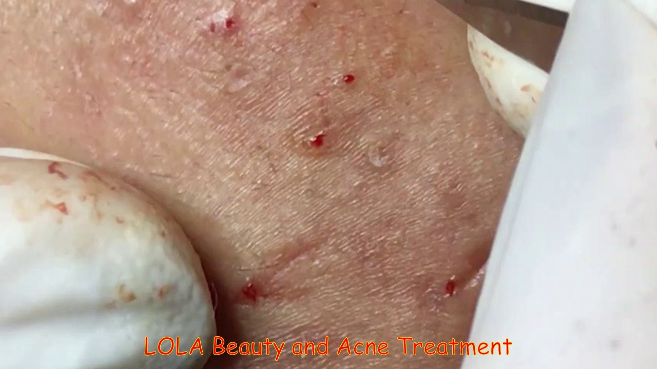 Whew! Redheads?;  Acne Removal 41;  (Full Screen) Super Big Pops