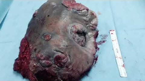 Limb salvage sarcoma resection By Sadir Alrawi