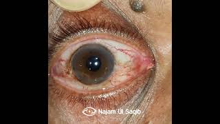 Intorsion/Extorsion Of the Globe after Peribulbar Anesthesia upon attempted Extraocular movements.