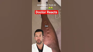 ER Doctor REACTS To Peripheral Edema 