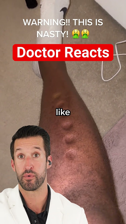 ER Doctor REACTS to Peripheral Edema