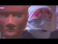 مراد بعد حرق وجهه