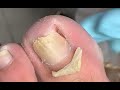 Ingrown nail cuticle cleaning