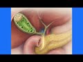Fundal Gallbladder Adenomyomatosis on Ultrasound &amp; MRI | Benign Mimicker of Gallbladder Mass