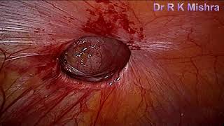 IPOM Umbilical Hernia Repair by VIPRO II Mesh