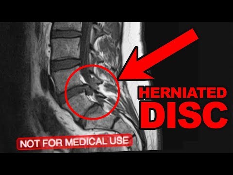 L4-L5 Micro Discectomy - 1 Year after my Herniated Disc Surgery