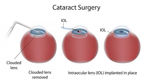 Cataract removal with lens implant CPT code - simplify medical coding