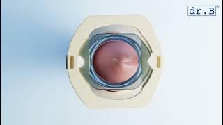 Dr. B Clamp Circumcision Device