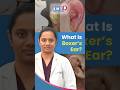 బాక్సర్ చెవి అంటే ఏమిటి? #decc #sportsinjurycare #cauliflowerear #earswelling #shorts #earinjury