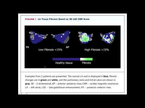 Vídeo: Associação Do índice De Volume Do átrio Esquerdo E Mortalidade Por Todas As Causas Em Pacientes Encaminhados Para Ressonância Magnética Cardiovascular De Rotina: Um Estudo Multicên