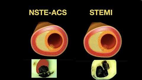 DAPT after ACS intervention