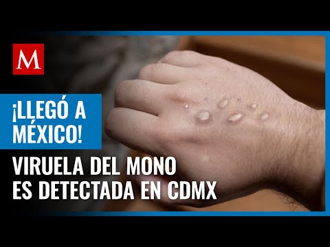 Detectan primer caso de viruela del mono en México