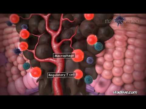 Video: Hipokerucocytosis Paraneoplastik Dalam Pesakit Melanoma Selepas Permulaan Terapi Gabungan Ipilimumab Dan Nivolumab