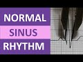 Understanding Normal Sinus Rhythm