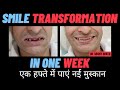 Smile Transformation (Real Patient) with Dental Bridge in 1 week; Dr. Srishti Bhatia